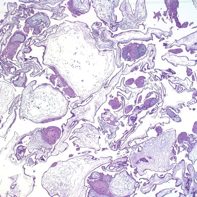 Low-power light microscopy of placental villous tissue from a hydatidiform mole. The slide demonstrates vesicular swelling (hydropic change) of chorionic villi with scalloped margins and diffuse villous edema. Trophoblastic proliferation is evident, appearing as nests and clusters of eosinophilic cytoplasm at the villous surface and within the stroma, consistent with trophoblastic hyperplasia. The severity of edema and hyperplasia varies from villus to villus. Fetal stromal blood vessels are usually absent, a hallmark distinguishing a complete mole from partial mole. The villi lack embryonic tissue, and the overall architecture shows circumferential trophoblastic proliferation around enlarged, hydropic villi. In some regions, hyalinization and cystic changes are visible, reflecting advanced hydropic degeneration. The image corresponds to a gonadotropin-secreting gestational trophoblastic disease with high risk of persistent GTN. Correlates with clinical findings such as markedly elevated hCG and potential uterine enlargement. This morphological pattern supports the differential diagnosis of complete mole versus partial mole or non-neoplastic hydropic changes. The pathology report would emphasize hydropic villi, diffuse trophoblastic hyperplasia, and absence of fetal vessels. This pattern is diagnostic of complete mole on histology and guides clinical management, including suction curettage, serial quantitative hCG monitoring, and pregnancy counseling.
