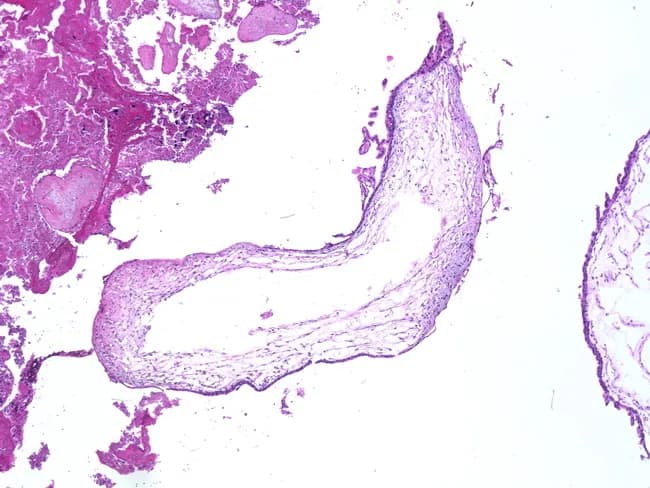 Histology of a complete hydatidiform mole. Imaging modality: light microscopy of hematoxylin and eosin (H&E) stained placental tissue, chorionic villi. The specimen shows a large, distended villous structure containing clear cisterns, hydropic degeneration of villous stroma, and a paucity of fetal tissue. The villi are edematous and markedly enlarged, with thickened, hyalinized stroma. The trophoblastic lining is attenuated but proliferative, forming a continuous layer of cytotrophoblast and syncytiotrophoblast around the villous cores. Nuclei of trophoblastic cells are enlarged, hyperchromatic, and pleomorphic, with frequent mitotic figures. These features are characteristic of a complete mole; paternal genomic contributions predominate in the trophoblast, while cytoplasm remains maternally derived. Most complete moles are diploid, commonly 46,XX or 46,XY, though occasional triploid or tetraploid cases occur. The absence of fetal tissue and fetal membranes supports the diagnosis of gestational trophoblastic disease rather than a normal or partial pregnancy. Clinically, complete moles present with markedly elevated beta-hCG and risk of persistent gestational trophoblastic disease or choriocarcinoma. Differential diagnosis includes partial mole (triploid with fetal tissue) and non-molar hydropic abortion. This image is clinically relevant for obstetrics, gynecologic oncology, and pathology education, and supports cytogenetic and molecular investigations of imprinting and paternal triploidy.