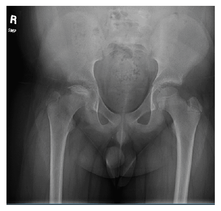 **Modality:** Anterior-posterior (AP) pelvic radiograph.

**Anatomy:** Pediatric pelvis including the bilateral proximal femurs, hips, and pelvic ring.

**Pathology:** Bilateral Legg-Calvé-Perthes disease (LCPD) or avascular necrosis of the femoral heads.

**Visual Features:**
- **Right Hip:** Significant fragmentation and flattening of the femoral capital epiphysis. Increased radiodensity (sclerosis) of the epiphysis is visible, indicating the necrotic phase. There is visible widening of the joint space and metaphyseal radiolucency.
- **Left Hip:** Subtle subchondral lucency (crescent sign) and mild flattening of the superior femoral head surface, consistent with early articular collapse.
- **General:** The triradiate cartilage is open, confirming a pediatric skeleton. The acetabular morphology appears preserved at this stage.

**Diagnostic Features:** Asymmetrical involvement of the bilateral femoral heads characterized by collapse, sclerosis, and fragmentation. These findings are diagnostic of osteochondrosis of the capital femoral epiphysis.

**Retrieval Keywords:** AP Pelvis X-ray, Legg-Calvé-Perthes disease, femoral head collapse, avascular necrosis, pediatric orthopedics, fragmentation phase, subchondral lucency.