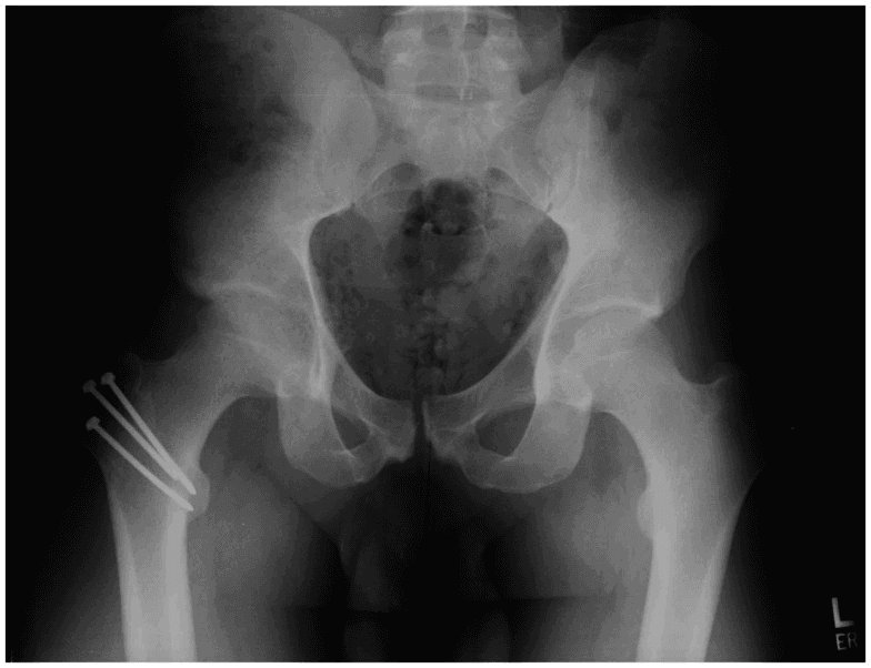 **Modality:** Anterior-posterior (AP) pelvic radiograph.

**Anatomy:** Pelvis and proximal femora, including the acetabular-femoral joints, iliac wings, and pubic symphysis.

**Observation:** The image demonstrates a postoperative state of the right hip. There is evidence of a completed trochanteric osteotomy. The osteotomy fragment is anatomically reduced and fixated using three cannulated metallic compression screws. The screws are oriented from the lateral aspect of the greater trochanter, extending medially and inferiorly toward the femoral neck/metaphysis.

**Pathology/Condition:** Postoperative surgical hip dislocation (Ganz approach). The right femoral head is reduced within the acetabulum with a preserved joint space. No acute fracture or hardware failure is visualized. The contralateral (left) hip joint appears unremarkable with normal joint space and osseous morphology.

**Differentiating Features:** Characteristic triple-screw fixation of the greater trochanter, commonly utilized for trochanteric flip osteotomy to provide surgical access to the acetabulum and femoral head while preserving vascularity. Overall pelvic alignment and pubic symphysis are within normal limits.