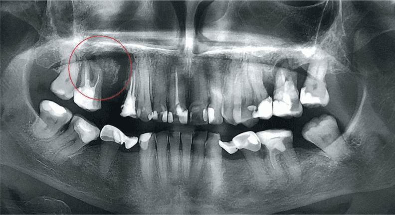 **Imaging Modality:** Panoramic Radiograph (Orthopantomogram).

**Anatomical Region:** Maxillofacial region, specifically the right posterior maxilla.

**Observed Pathology:** Bone sequestrum associated with chronic osteomyelitis or osteonecrosis.

**Visual Features:**
- **Primary Finding:** A well-defined, radiopaque island of non-vital bone (sequestrum) is visible in the right maxillary alveolar process, highlighted by a red circle.
- **Surrounding Architecture:** The sequestrum is partially surrounded by a radiolucent zone (involucrum), indicating separation from the healthy bone.
- **Dental Findings:** Generalized severe horizontal and vertical bone loss consistent with advanced periodontal disease. Multiple teeth exhibit extensive dental caries, restorations, and periapical radiolucencies. Several teeth are displaced or show signs of significant attachment loss.
- **Maxillary Sinuses:** The right maxillary sinus floor appears closely approximated or involved by the inflammatory process.

**Key Diagnostic Features:**
- Presence of an isolated, dense radiopaque fragment within an area of radiolucency.
- Mottled or "moth-aten" appearance of the surrounding trabecular bone pattern.
- Clinical correlation typically involves Medication-Related Osteonecrosis of the Jaw (MRONJ) or chronic suppurative osteomyelitis.