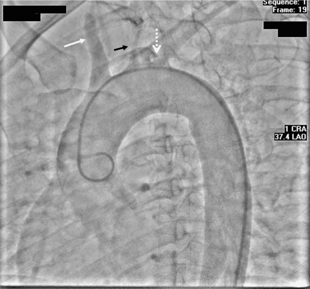 **Imaging Modality:** Digital Subtraction Angiogram (DSA), Aortic Arch Study.

**Anatomical Region:** Aortic arch and supra-aortic branches, including the brachiocephalic trunk, left common carotid artery, and left subclavian artery.

**Observed Pathology:**
*   **Brachiocephalic Artery:** Significant high-grade stenosis at the proximal segment (indicated by the white arrow).
*   **Left Common Carotid Artery:** Complete proximal occlusion with no distal contrast opacification (indicated by the solid black arrow).
*   **Left Subclavian Artery:** Complete proximal occlusion at the origin from the aortic arch (indicated by the dashed white arrow).

**Characteristic Visual Features:** The image demonstrates a pigtail catheter positioned in the ascending aorta. There is a profound lack of normal contrast runoff into the primary arch vessels. The only remaining patent pathway for cerebral perfusion is via the severely stenosed right-sided brachiocephalic circulation.

**Clinical Context:** These findings are characteristic of advanced aortoarteritis (such as Takayasu arteritis) or severe multi-vessel atherosclerotic disease, resulting in "pulseless" clinical presentation and critical cephalic ischemia.

**Diagnostic Features:** Multi-vessel proximal occlusion/stenosis involving the great vessels of the aortic arch, visualized in a Left Anterior Oblique (LAO) cranially angulated projection.