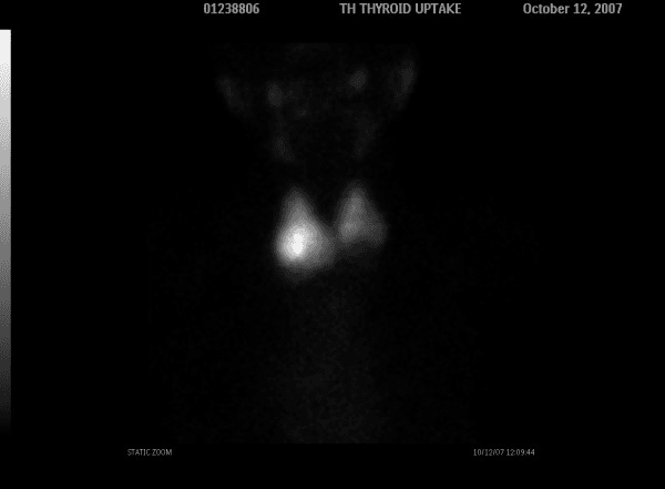 **Imaging Modality:** Nuclear medicine radionuclide scan (Thyroid Scintigraphy) using Technetium-99m (99mTc) pertechnetate.

**Anatomical Region:** Anterior view of the neck demonstrating the thyroid gland.

**Observed Pathology:** Focal area of decreased radionuclide uptake (photopenia) located in the inferior pole of the left thyroid lobe. 

**Characteristic Visual Features:**
* **Thyroid Morphology:** The right thyroid lobe and superior portion of the left lobe demonstrate relatively homogenous tracer distribution.
* **Cold Nodule:** A well-defined "cold" or non-functioning nodule is visible at the lower aspect of the left lobe, characterized by a lack of tracer accumulation compared to the surrounding functional thyroid parenchyma.
* **Salivary Glands:** Incidental visualization of tracer uptake in the submandibular and parotid glands is noted superiorly, consistent with normal biodistribution.

**Key Diagnostic Features:** The presence of a solitary cold nodule on a 99mTc thyroid scan is a critical finding for evaluating thyroid pathology, as it indicates a focal region of suppressed biochemical activity or replaced thyroid tissue. This finding necessitates further clinical correlation, typically via ultrasonography and fine-needle aspiration biopsy (FNAB).