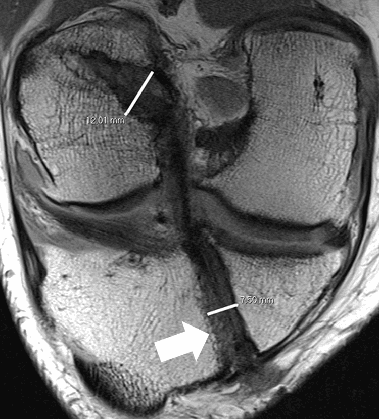 **Imaging Modality:** Oblique coronal proton density-weighted (PDW) magnetic resonance imaging (MRI).

**Anatomical Region:** Right knee joint focusing on the intercondylar notch and proximal tibia.

**Observed Pathology/Post-operative Status:** Status post-anterior cruciate ligament (ACL) reconstruction. The image demonstrates the morphology of the surgical tunnels and the ACL graft.

**Characteristic Visual Features:**
*   **Femoral Tunnel:** An anteromedial (AM) femoral tunnel is visible with a conical, widened morphology, measured at a diameter of 12.01 mm.
*   **Tibial Tunnel:** An evenly narrowed tibial AM tunnel is observed, measured at 7.50 mm. 
*   **ACL Graft:** A continuous, low-signal intensity band representing the ACL graft is seen traversing the joint space between the femoral and tibial tunnels.
*   **Hardware:** A white arrow indicates the position of an interference screw within the tibial tunnel, partially obscured by susceptibility artifact.

**Differentiating Features:** The image highlights tunnel widening (conical femoral tunnel) versus uniform tunnel maintenance (tibial tunnel), which is critical for assessing post-operative graft stability and potential tunnel osteolysis.