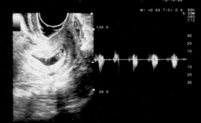 **Imaging Modality:** Transvaginal Ultrasound (TVUS) with Spectral Doppler.

**Anatomical Region:** Female pelvis, specifically the cervix and endocervical canal.

**Observed Pathology:** Cervical ectopic pregnancy. The image demonstrates a well-defined gestational sac containing a visible embryo implanted within the cervical stroma, below the level of the internal os.

**Characteristic Visual Features:**
*   **Gestational Sac:** An anechoic, oval-shaped structure is situated within the cervical canal, separate from the uterine cavity.
*   **Embryonic Findings:** A fetal pole is visible within the sac, consistent with approximately seven weeks of gestation.
*   **Cardiac Activity:** The right panel displays a Spectral Doppler waveform (M-mode/Pulse Wave) confirming rhythmic embryonic cardiac activity, indicating a viable ectopic pregnancy.
*   **Uterine Landmark:** The empty uterine cavity (not fully visualized but implied by the low anatomical positioning) helps differentiate this from an intrauterine pregnancy.

**Key Diagnostic Features:** The "hourglass" appearance of the uterus and the presence of a viable embryo within the cervix are pathognomonic for a cervical ectopic pregnancy, distinguishing it from an ongoing spontaneous abortion (miscarriage in progress) by the presence of peritrophoblastic flow and a fixed position within the cervical wall.
