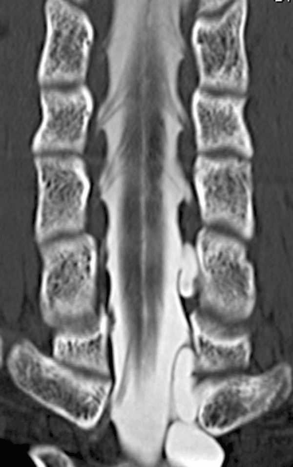 **Imaging Modality:** Computerized Tomography (CT) Myelography.

**Anatomical Region:** Cervical spine, coronal reformatted view.

**Observed Structures and Features:**
The image displays a coronal cross-section of the spinal canal with intrathecal contrast enhancement. The spinal cord is centrally located, flanked by hyperdense contrast material within the subarachnoid space. High-resolution visualization demonstrates multiple bilateral ventral nerve rootlets arising from the spinal cord and traversing the subarachnoid space toward the neural foramina.

**Key Findings:**
- **Nerve Root Morphology:** The fine linear structures represent the ventral rootlets, appearing as discrete filling defects against the bright contrast.
- **Bony Anatomy:** Adjacent vertebral bodies and pedicles are visible, providing anatomical orientation for segmenting the nerve roots.
- **Pathology:** On the left side of the lower aspect of the image, there is evidence of traumatic nerve root avulsion, characterized by the absence of normal rootlet patterns and the presence of prominent pseudomeningoceles (extrathecal contrast collections) extending through the neural foramina.

**Clinical Utility:** This imaging technique is utilized for the high-resolution assessment of preganglionic nerve root integrity and the diagnosis of brachial plexus injuries or root avulsions.
