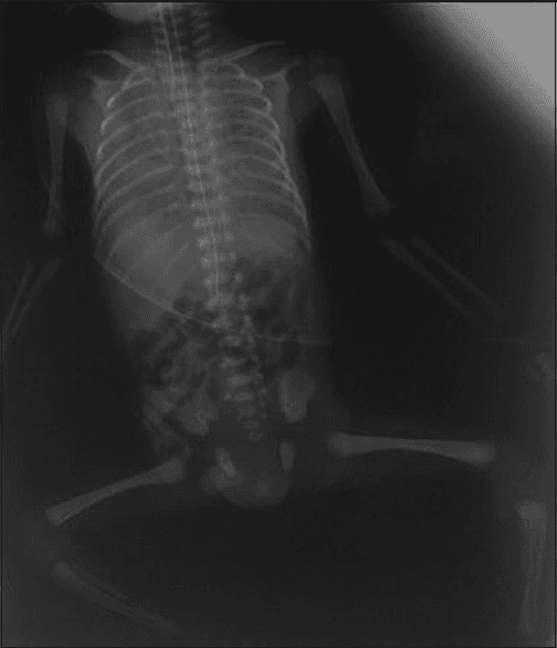 **Imaging Modality:** Anteroposterior (AP) conventional radiograph (X-ray).

**Anatomical Region:** Neonatal chest and abdomen.

**Observed Pathology:** The image demonstrates classic findings of Respiratory Distress Syndrome (RDS), also known as Hyaline Membrane Disease. The lung fields exhibit diffuse, bilateral, and symmetric "ground-glass" opacification with a fine reticulogranular pattern. There is a notable loss of lung volume (low lung volumes).

**Characteristic Visual Features:**
*   **Parenchymal Pattern:** Diffuse reticulogranular densities (micranodular mottling) throughout both lungs.
*   **Air Bronchograms:** Prominent lucent tubular structures representing air-filled bronchi outlined by non-aerated alveoli, extending peripherally.
*   **Cardiac Silhouette:** The borders of the heart and diaphragm are obscured (silhouette sign) due to the extensive alveolar collapse and opacification.
*   **Support Devices:** An endotracheal tube and an umbilical venous catheter are visible, consistent with neonatal intensive care management.

**Differentiating Features:** The combination of low lung volumes, bell-shaped thorax, and diffuse ground-glass appearance distinguishes this from neonatal pneumonia or transient tachypnea of the newborn.