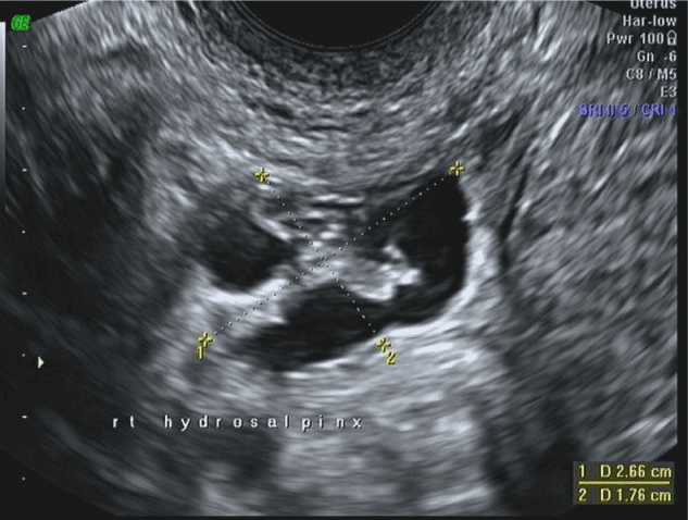 **Imaging Modality:** Transvaginal Ultrasound (TVUS), B-mode.

**Anatomical Region:** Female pelvis, right adnexa.

**Observed Pathology:** Hydrosalpinx.

**Characteristic Visual Features:** The image demonstrates a prominent, elongated, tubular cystic structure in the adnexa. The mass is primarily anechoic to hypoechoic, indicating fluid collection within a dilated fallopian tube. Distinctive "waist signs" or indentations along the opposite walls of the tube are visible, creating a multiloculated appearance often referred to as a "cogwheel" or "beads-on-a-string" sign in cross-section. 

**Diagnostic Features:** The structure is separate from the ovary (not visualized in this plane) and lacks the thick, vascularized walls characteristic of a tubo-ovarian abscess or pyosalpinx. Electronic calipers measure the maximal dimensions of the dilated segment (approximately 2.66 cm x 1.76 cm). The presence of incomplete septa (indentations) is a key differentiating feature that distinguishes a dilated fallopian tube from other pelvic cystic adnexal masses such as para-ovarian cysts.

**Clinical Context:** Findings are diagnostic of tubal dilation and fluid accumulation, consistent with chronic tubal occlusion and hydrosalpinx in a reproductive-age patient.