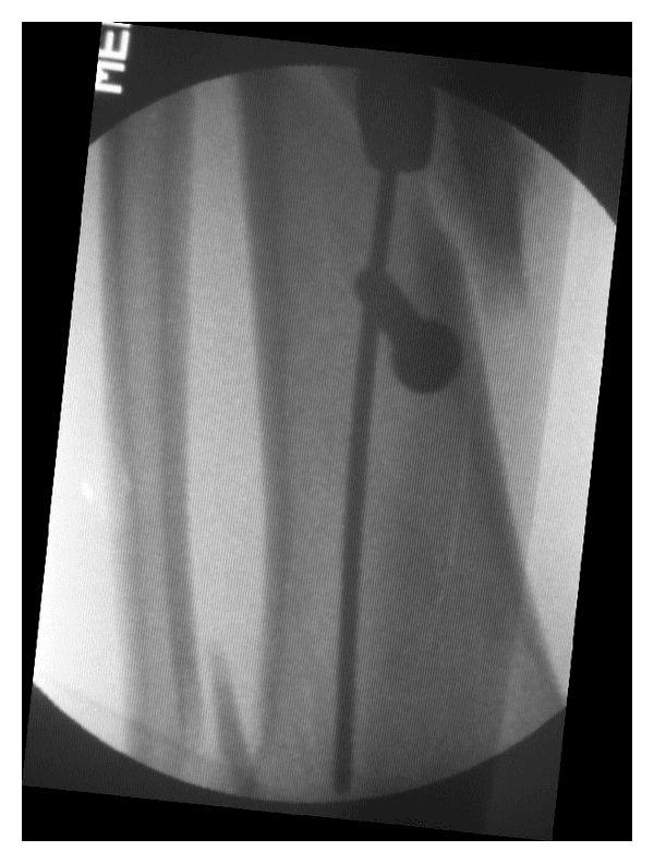 **Imaging Modality:** Intraoperative fluoroscopy (C-arm X-ray).

**Anatomical Region:** Long bone diaphysis, likely the tibia or femur.

**Observed Pathology/Procedures:** 
The image demonstrates an orthopedic surgical procedure involving intramedullary (IM) nailing for fracture fixation. A radiopaque intramedullary nail is visible traversing the medullary canal. 

**Characteristic Visual Features:**
- **Poller (Blocking) Screw:** A single, large-diameter radiopaque screw is positioned perpendicular to the long axis of the bone, situated on the concave side of the deformity near the fracture site in the distal segment. 
- **Nail-Screw Interaction:** The Poller screw is strategically placed to narrow the medullary canal, acting as a physical guide to redirect the intramedullary nail. This contact ensures central alignment within the distal fragment and prevents malalignment (valgus/varus or prorecurvatum/recurvatum) during insertion.
- **Hardware Positioning:** The distal tip of the IM nail is visible extending past the level of the blocking screw.

**Key Diagnostic Features:** 
The primary feature is the utilization of a blocking screw (Poller screw technique) to achieve indirect reduction and stability of an intramedullary nail in a wide metadiaphyseal region or a distal fracture segment.