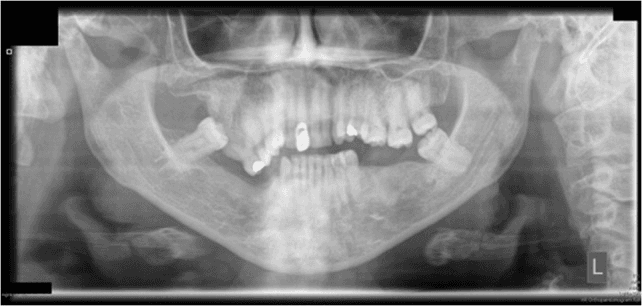 **Imaging Modality:** Orthopantomogram (OPG/Panoramic Radiograph)

**Anatomical Region:** Maxillofacial region, focusing on the maxilla, mandible, and dentition.

**Observed Pathology:** There is a significant expansile lesion involving the right maxillary tuberosity and posterior maxilla. The lesion demonstrates a "ground-glass" or "orange-peel" internal radiopacity, characteristic of fibro-osseous dysplasia. 

**Characteristic Visual Features:**
*   **Expansion:** Marked buccolingual and superior expansion of the right maxillary alveolar process.
*   **Bony Pattern:** A diffuse, poorly demarcated area of increased radiodensity with a granular texture replacing normal trabecular patterns.
*   **Effect on Surrounding Structures:** The lesion causes superior displacement of the floor of the right maxillary sinus. 
*   **Dentition:** Generalized dental crowding, multiple missing teeth, and evidence of previous restorative work (radiopaque fillings). An impacted or displaced molar is visible in the right posterior maxilla, potentially associated with the expansile mass.

**Diagnostic Cues:** The poorly defined borders and characteristic ground-glass opacity in a craniofacial bone are highly suggestive of fibrous dysplasia or a related fibro-osseous entity. No aggressive cortical destruction or sunburst periosteal reaction is visualized.