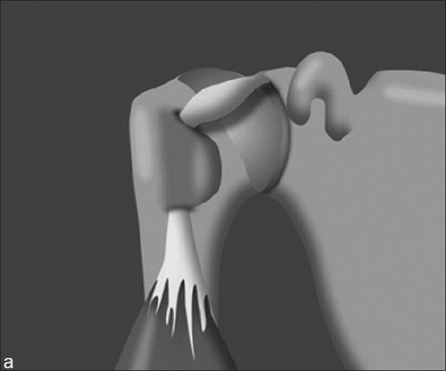 **Imaging Modality:** Medical illustration/diagram.

**Anatomical Region:** Shoulder joint (glenohumeral joint), specifically the anterosuperior aspect.

**Observed Pathology/Entity:** Hypertrophy of the long head of the biceps (LHB) tendon.

**Characteristic Visual Features:**
The illustration depicts a three-dimensional rendering of the shoulder anatomy with the humerus in a neutral position (arm at the side). The long head of the biceps tendon is shown originating from the supraglenoid tubercle and passing through the bicipital groove. The intra-articular portion of the LHB tendon exhibits significant fusiform thickening and enlargement (hypertrophy) compared to its distal portion. Key landmarks visible include the humeral head, the greater and lesser tuberosities forming the bicipital groove, the coracoid process, and the glenoid.

**Clinical Context:**
This finding is often associated with chronic tendinopathy or the "hourglass biceps" phenomenon, where the enlarged tendon becomes mechanically trapped or restricted within the bicipital groove during joint motion, potentially leading to pain and limited range of motion (terminal elevation).

**Key Diagnostic Features:**
- Pronounced thickening of the intra-articular LHB tendon segment.
- Positioned within the glenohumeral space proximal to the intertubercular sulcus.
