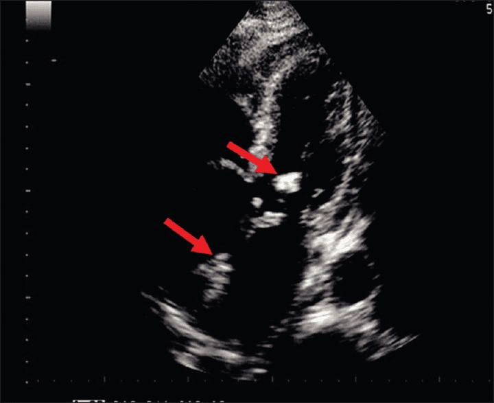 **Imaging Modality:** Transthoracic echocardiogram (TTE), grayscale B-mode.

**Anatomical Region:** Parasternal long-axis view of the heart, focusing on the left ventricular outflow tract (LVOT), aortic valve, and mitral valve apparatus.

**Observed Pathology:** Infective endocarditis presenting as multiple valvular vegetations. Two prominent, irregular, echogenic masses are identified (marked by red arrows).

**Characteristic Visual Features:**
*   **Vegetations:** Highly echogenic, mobile-appearing pedunculated masses. 
*   **Distribution:** One vegetation is localized to the non-coronary cusp of the aortic valve. A second, larger vegetation is attached to the atrial surface of the anterior mitral valve leaflet.
*   **Morphology:** The masses exhibit heterogeneous echogenicity and irregular borders, characteristic of fibrin-platelet-bacterial aggregations.

**Key Diagnostic Features:** The simultaneous involvement of the aortic and mitral valves suggests "kissing vegetations" or contiguous spread of infection. These findings are primary diagnostic criteria for definitive infective endocarditis according to the Modified Duke Criteria. The image lacks color Doppler, but the anatomical positioning indicates a high risk for valvular regurgitation and embolic events.