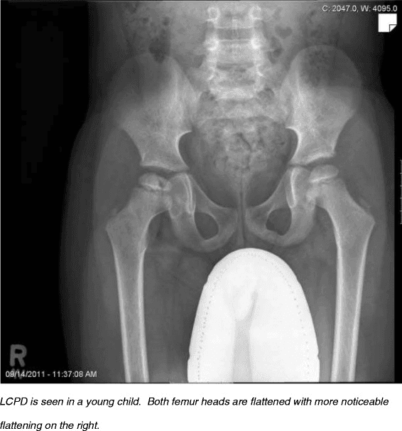 **Imaging Modality:** Anteroposterior (AP) pelvic radiograph (X-ray).

**Anatomical Region:** Pediatric pelvis and bilateral hip joints.

**Observed Pathology:** Bilateral Legg-Calvé-Perthes Disease (LCPD), characterized by idiopathic avascular necrosis of the proximal femoral epiphyses. 

**Characteristic Visual Features:**
*   **Femoral Heads:** Significant bilateral flattening (coxa plana), fragmentation, and increased radiopacity (sclerosis) of the capital femoral epiphyses.
*   **Symmetry:** The findings are asymmetrical, with more pronounced collapse and fragmentation observed on the right femoral head compared to the left.
*   **Joint Space:** Preservation of the joint space is noted, though the right femoral head shows lateral subluxation/extrusion relative to the acetabulum.
*   **Femoral Necks:** Relative widening and shortening of the bilateral femoral necks (coxa magna) are visible, consistent with remodeling secondary to epiphyseal ischemia.

**Diagnostic Differentiating Features:** The combination of epiphyseal flattening, fragmentation, and sclerosis in a skeletally immature patient is pathognomonic for the fragmentation or re-ossification stages of Legg-Calvé-Perthes disease. The absence of destructive articular changes helps differentiate this from septic arthritis or inflammatory arthropathies.