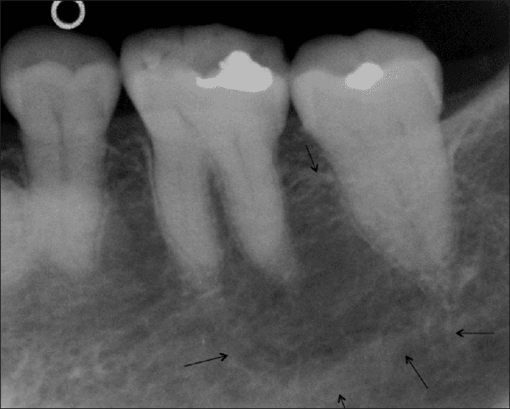 **Imaging Modality:** Periapical intraoral radiograph.

**Anatomical Region:** Posterior mandible or maxilla (molar region), specifically focusing on the first and second molars.

**Observed Pathology:** The radiograph demonstrates normal hard tissue structures with no overt evidence of periapical radiolucency, widening of the periodontal ligament space, or significant alveolar bone loss. The trabecular bone pattern appears within normal physiological limits.

**Characteristic Visual Features:**
*   **Restorations:** Radio-opaque (metallic) occlusal restorations are visible on the first and second molars.
*   **Anatomy:** Clear visualization of the crown, pulp chamber, root canals, and lamina dura. 
*   **Landmarks:** Black arrows at the inferior portion of the image indicate the borders of an anatomical canal, likely the inferior alveolar nerve canal (if mandibular) or a similar neurovascular landmark. 
*   **Bone Density:** Homogeneous distribution of trabecular bone without sequestra or osteolytic lesions.

**Diagnostic Context:** This image serves as a baseline radiographic study for a clinically asymptomatic tooth. The absence of radiographic inflammation or periodontal pathology supports a diagnosis of a healthy periradicular status despite the presence of dental restorations.