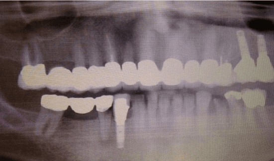 **Imaging Modality:** Orthopantomogram (Panoramic Dental X-ray).

**Anatomical Region:** Maxilla and mandible with associated dentition.

**Observed Pathology:** Medication-related osteonecrosis of the jaw (MRONJ).

**Characteristic Visual Features:** 
The radiograph demonstrates ill-defined radiolucent and mixed radiopaque-radiolucent (moth-eaten) bone destruction. There is evidence of cortical bone erosion and sequestration, particularly noted in the alveolar regions. Findings include non-healing extraction sockets and widened periodontal ligament spaces.

**Dental Status and Landmarks:** 
Extensive dental restorations are visible, including multiple radiopaque fixed prosthodontic bridges (maxillary and mandibular) and endosseous dental implants. There is significant generalized alveolar bone loss consistent with periodontitis.

**Diagnostic Differentiating Features:** 
The combination of localized sequestrum formation, osteosclerosis, and persistent radiolucency in a patient with a history of bisphosphonate therapy is characteristic of drug-induced osteonecrosis. These features distinguish the condition from simple osteomyelitis or primary bone malignancy by the specific pattern of bone turnover suppression and necrotic bone involvement.