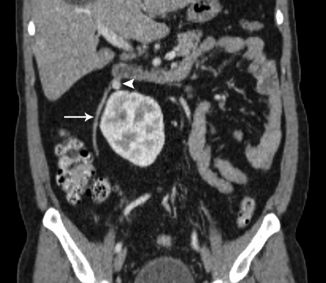 **Modality:** Contrast-enhanced Computed Tomography (CECT).
**View:** Coronal reconstruction.
**Anatomical Region:** Abdomen, specifically the retroperitoneum showing the renal and gonadal vasculature.

**Key Findings:**
- **Vascular Anatomy:** The image demonstrates a congenital vascular variation involving the right testicular (gonadal) vein.
- **Anomalous Drainage:** The right testicular vein (indicated by the arrow) is seen ascending laterally to the inferior vena cava (IVC) and crossing medially to drain directly into the left renal vein (indicated by the arrowhead) instead of its typical insertion point into the anterolateral IVC.
- **Landmarks:** Visible structures include the inferior pole of the liver, the right kidney, and the elongated left renal vein crossing the midline.

**Diagnostic Significance:** This represents a rare anatomical variant of the gonadal venous system. Identification of such anomalies is clinically significant for preoperative planning in retroperitoneal surgeries, renal transplantation, and interventional radiological procedures such as varicocele embolization.

**Search Terms:** CECT abdomen, coronal CT, anomalous right testicular vein, right gonadal vein variation, left renal vein drainage, retroperitoneal vascular anatomy.