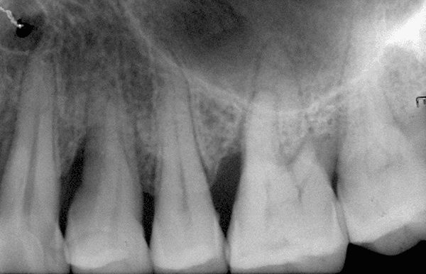 **Imaging Modality:** Intraoral periapical radiograph.

**Anatomical Region:** Maxillary posterior dentition, including premolars and molars.

**Observed Pathology/Disease Entity:** 
- **Periodontal Bone Loss:** Evidence of generalized horizontal bone loss and localized vertical (angular) osseous defects.
- **Furcation Involvement:** Visible radiolucency in the furcation area of the depicted maxillary molar, indicating Class II or III furcation involvement.
- **Dental Caries:** Radiopacities and radiolucencies suggest possible interproximal caries and existing dental restorations.

**Characteristic Visual Features:**
- **Alveolar Crest:** The crestal bone is apical to the normal level (1–2 mm below the cemento-enamel junction), indicating chronic periodontitis.
- **Trabecular Pattern:** Normal to slightly decreased density of the interdental bone.
- **Root Morphology:** Clearly visible root canals and periodontal ligament (PDL) spaces; some widening of the PDL space is noted.
- **Anatomical Landmarks:** The floor of the maxillary sinus is visible superior to the root apices.

**Key Diagnostic Features:**
Presence of significant clinical attachment loss as evidenced by the radiographic distance between the CEJ and the alveolar crest, and the involvement of multi-rooted teeth furcations.