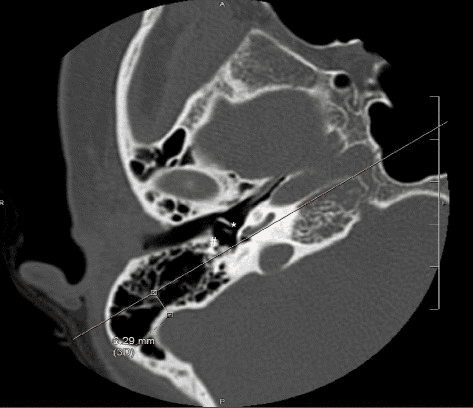 **Imaging Modality:** High-resolution computed tomography (HRCT) of the temporal bone.

**Anatomical Region:** Axial section of the right petrous temporal bone and middle ear.

**Key Landmarks and Features:**
The image displays the internal auditory canal, the cochlea, and the pneumatized mastoid air cells. Specific annotation marks identify the round window niche (*) and the descending (mastoid) segment of the facial nerve (#). A linear trajectory is projected passing through these two anatomical landmarks, extending posteriorly toward the mastoid cortex.

**Measurements and Observations:**
A quantitative measurement of 6.29 mm is visible, representing the distance between the reference line (aligned with the round window and facial nerve) and the anterior border of the sigmoid sinus. The sigmoid sinus is visualized as a well-defined cortical groove posterior to the mastoid antrum. 

**Clinical Context:**
This preoperative measurement assesses the surgical corridor for a posterior tympanotomy or cochlear implantation. It evaluates the degree of sigmoid sinus anteriorization, which can influence surgical access to the middle ear via the facial recess. The image demonstrates a standard anatomical relationship without evidence of ossicular pathology or significant mastoid opacification.