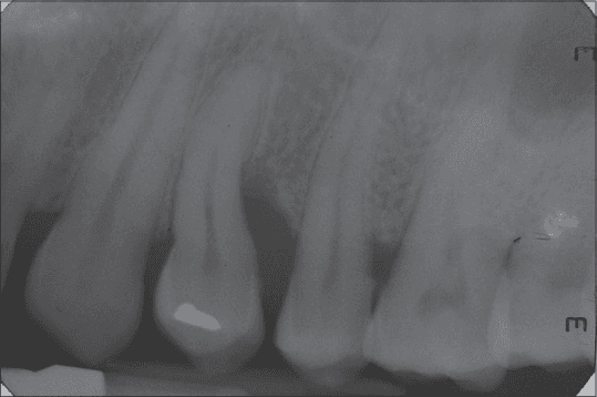 **Imaging Modality:** Intraoral periapical radiograph.

**Anatomical Region:** Maxillary posterior quadrant, including premolar and molar regions.

**Observed Pathology:** Advanced periodontal bone loss. There is significant localized vertical (angular) bone loss and horizontal bone resorption affecting the interdental alveolar crests. 

**Characteristic Visual Features:** 
- **Bone Loss:** A deep, U-shaped radiolucent vertical defect is visible between the second premolar and first molar, extending towards the middle third of the roots.
- **Dentition:** The radiograph shows permanent maxillary teeth with visible pulp chambers and root canal morphology. A radiopaque restoration is noted on the occlusal/coronal surface of the second premolar.
- **Periodontal Ligament (PDL):** Widening of the PDL space is suggestive of secondary occlusal trauma or active inflammatory periodontal disease.
- **Trabecular Pattern:** Normal to slightly decreased radiodensity of the surrounding alveolar bone.

**Key Diagnostic Features:** Presence of severe interproximal vertical osseous defects and reduction in the height of the alveolar crest relative to the cemento-enamel junction (CEJ), characteristic of chronic periodontitis.