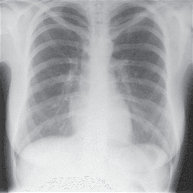 **Imaging Modality:** Posteroanterior (PA) or Anteroposterior (AP) Chest X-ray.

**Anatomical Region:** Thoracic cavity, including the lungs, mediastinum, heart, and diaphragm.

**Observed Pathology:** The radiograph demonstrates a significant degree of hyperlucency in both lung fields, consistent with pulmonary hyperinflation. There is a notable flattening of the bilateral hemidiaphragms, which is a classic indicator of chronic obstructive pulmonary disease (COPD) or emphysema. 

**Characteristic Visual Features:** 
- **Lung Fields:** Increased radiolucency and expansion of the thoracic volume.
- **Diaphragm:** Flattening of the diaphragmatic contour and widening of the costophrenic angles.
- **Heart:** The cardiac silhouette appears relatively narrow or "tubular," often seen in the context of hyperinflated lungs.
- **Ribs:** Increased horizontal orientation of the ribs and widening of the intercostal spaces.

**Diagnostic Differentiating Features:** The combination of bilateral lung hyperlucency, flattened diaphragms, and a narrow mediastinal silhouette supports a diagnosis of obstructive airway disease rather than acute consolidation or pleural effusion. No focal masses, pneumothorax, or acute airspace opacities are visualized.