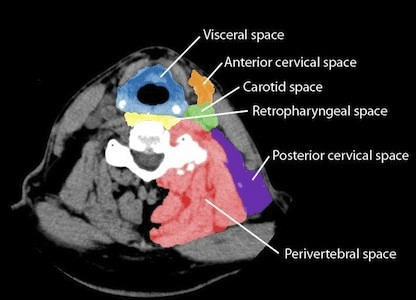 **Modality:** Axial Computed Tomography (CT) scan of the neck.

**Anatomical Region:** Mid-cervical level (suprahyoid/infrahyoid junction), displaying the cervical vertebrae, airway, and surrounding soft tissue structures.

**Description:** This is an educational anatomical diagram utilizing digital color-coding to delineate the deep cervical fascia compartments on the left side of a normal neck. The image serves as a reference for the topographic anatomy of potential neck spaces.

**Key Landmarks and Color-Coded Spaces:**
*   **Visceral Space (Blue):** Encompasses the midline structures including the trachea, esophagus, and thyroid gland.
*   **Anterior Cervical Space (Orange):** Located anterior to the carotid space.
*   **Carotid Space (Green):** Contains the carotid artery, internal jugular vein, and cranial nerves IX–XII.
*   **Retropharyngeal Space (Yellow):** Positioned between the visceral fascia and the prevertebral fascia.
*   **Perivertebral Space (Red):** Surrounds the cervical vertebra and paraspinal muscles.
*   **Posterior Cervical Space (Purple):** Located posterior and lateral to the carotid space, deep to the sternocleidomastoid muscle.

**Clinical Significance:** Essential for localizing pathology, such as abscesses or neoplasms, and predicting the spread of infection along fascial planes.