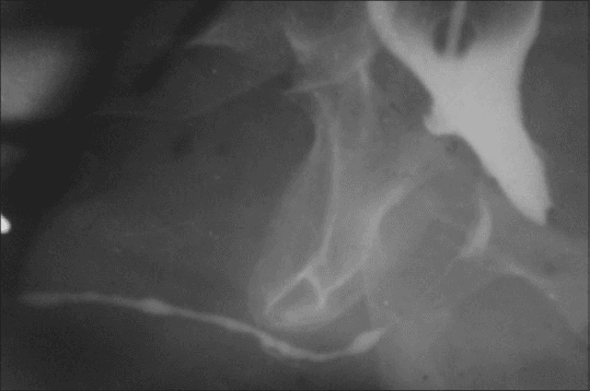 **Imaging Modality:** Retrograde urethrogram (RUG).

**Anatomical Region:** Lower urinary tract, specifically the male urethra and bladder base.

**Observed Pathology:** The image demonstrates a significant urethral stricture consistent with Balanitis Xerotica Obliterans (BXO) involvement. There is a long-segment, irregular narrowing of the anterior urethra, particularly involving the pendulous and distal segments. 

**Characteristic Visual Features:** 
- **Stricture Morphology:** A high-grade, elongated, and irregular filiform narrowing of the urethral lumen is visible.
- **Contrast Distribution:** Radiopaque contrast medium depicts a markedly attenuated urethral caliber with areas of bead-like pooling and proximal segments appearing relatively unaffected compared to the distal involvement.
- **Landmarks:** The contrast-filled bladder is partially visible superiorly, showing irregular contours that may suggest secondary changes such as bladder wall thickening or trabeculation due to chronic outlet obstruction.

**Diagnostic Features:** The diffuse and long-segment nature of the anterior urethral narrowing in the clinical context of BXO (Lichen Sclerosus) distinguishes this from localized post-traumatic or iatrogenic strictures. The presence of significant luminal reduction indicates severe obstructive uropathy.