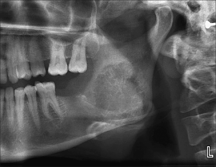 **Modality:** Orthopantomogram (OPG) / Panoramic Radiograph.

**Anatomical Region:** Left posterior mandible, specifically the region of the angle and ascending ramus.

**Observed Pathology:** Large, ill-defined, mixed radiolucent-radiopaque lesion involving the left mandibular ramus and angle. The lesion demonstrates aggressive features with infiltrative borders.

**Characteristic Visual Features:**
*   **Bone Pattern:** Classic "sunburst" or "sunray" appearance characterized by divergent spicules of periosteal new bone formation radiating perpendicular to the cortical surface.
*   **Cortical Integrity:** Significant expansion and destruction of the buccal and lingual cortical plates.
*   **Dental Impact:** Displacement and potential resorption of adjacent molar roots are visible.
*   **Soft Tissue:** Evidence of a soft tissue mass extending beyond the bony confines of the mandible.

**Clinical Context:** These radiographic findings are highly suggestive of an osteosarcoma of the mandible or a similar primary malignant bone tumor.

**Key Diagnostic Features:** The presence of a poorly demarcated lesion with a radiating spiculated periosteal reaction ("sunburst" pattern) in the jaw is a hallmark for osteosarcoma, differentiating it from benign odontogenic cysts or tumors.