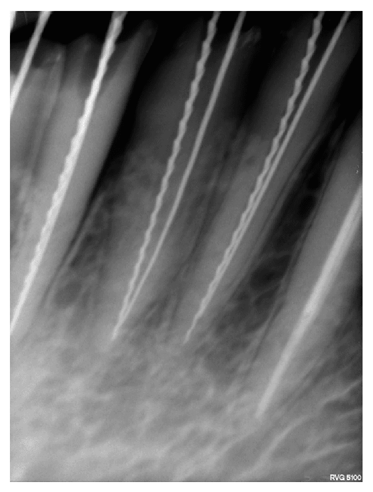 **Imaging Modality:** Intraoral periapical radiograph (digital).

**Anatomical Region:** Mandibular anterior segment, specifically visualizing the mandibular right permanent central incisor (FDI 41) and lateral incisor (FDI 42).

**Observed Findings:**
The image depicts an endodontic working length determination or instrumentation phase. Both teeth 41 and 42 exhibit anatomical variations in the form of two distinct root canals per tooth (labial and lingual/palatal). 

**Characteristic Visual Features:**
Four radiopaque endodontic instruments are visible within the root canal systems:
*   **Hedström (H-type) Files:** Identified by their characteristic teardrop-shaped, fluted profile with sharp, stacked cones, positioned in the distal/lingual canals.
*   **Reamers:** Identified by a more slender, twisted triangular or square cross-sectional appearance with a coarser pitch compared to the H-files, positioned in the mesial/labial canals.

**Clinical Context:**
The radiograph confirms the presence of dual canals in mandibular incisors, a critical morphological finding for successful endodontic therapy. The use of different instrument types (H-file vs. Reamer) serves as a visual marker to differentiate between the buccal and lingual canals on a two-dimensional radiographic plane. The surrounding alveolar bone shows a normal trabecular pattern.