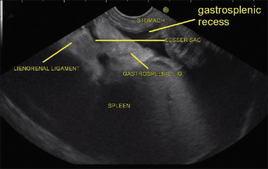 **Imaging Modality:** Endoscopic Ultrasound (EUS)

**Anatomical Region:** Upper abdomen, specifically the left upper quadrant focusing on the perisplenic space and gastric anatomy.

**Key Landmarks and Visual Features:**
This ultrasound image demonstrates the anatomical relationships between the spleen, stomach, and their supporting ligamentous structures. The spleen is visible as a large, homogeneous, moderately echogenic organ in the lower portion of the sector. Superior and adjacent to the splenic hilum, the following structures are identified and labeled:
*   **Gastrosplenic Ligament:** Visible as an echogenic band connecting the splenic hilum to the stomach.
*   **Lienorenal (Splenorenal) Ligament:** An echogenic ligamentous attachment extending toward the retroperitoneum.
*   **Stomach:** Positioned at the top of the image near the transducer interface.
*   **Gastrosplenic Recess and Lesser Sac:** These potential spaces are identified as hypoechoic (fluid-filled) areas adjacent to the ligamentous attachments.

**Clinical Context:** This image serves as a reference for EUS-based identification of perisplenic ligaments and the boundaries of the lesser sac, essential for navigating the omental bursa and identifying regional vascular or lymph node pathology during diagnostic procedures.
