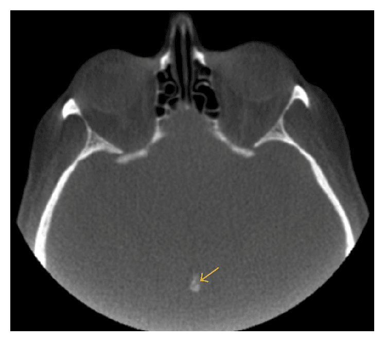**Imaging Modality:** Non-contrast Computed Tomography (CT) of the head.

**Anatomical Region:** Axial section at the level of the midbrain and suprasellar cistern, including the posterior cranial fossa and orbits.

**Observed Findings:** There is a distinct, hyperdense, well-circumscribed focus located in the midline of the brain, corresponding to the anatomical position of the pineal gland. This finding represents physiological pineal gland calcification (corpora arenacea). The calcification is centrally positioned with no evidence of mass effect or midline shift.

**Characteristic Visual Features:** The lesion exhibits high attenuation (radiodensity) consistent with calcium deposition. An orange arrow highlights the specific site of the calcification. Surrounding brain parenchyma appears grossly homogeneous within the limits of the bone window settings.

**Diagnostic Context:** This is a common, typically benign, age-related finding in adult neuroimaging. It serves as a critical radiographic landmark for assessing midline structures and identifying potential pineal region pathology or shift due to intracranial pressure.