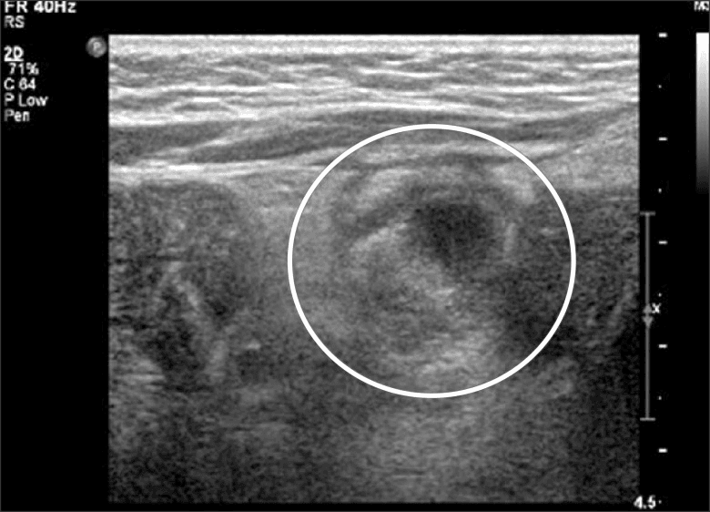 **Imaging Modality:** Abdominal Ultrasonography (USG), grayscale B-mode.

**Anatomical Region:** Infraumbilical abdominal wall and underlying peritoneal cavity.

**Observed Pathology:** A well-defined cystic mass is localized in the subumbilical region. The lesion demonstrates a complex internal echo pattern characterized by heterogeneous echogenic material within a predominantly hypoechoic fluid collection.

**Characteristic Visual Features:**
*   **Morphology:** Ovoid to tubular cystic structure (highlighted by a white circular annotation).
*   **Internal Echoes:** Presence of low-level internal echoes and debris, indicating a non-simple fluid composition (consistent with proteinaceous material, hemorrhage, or infection).
*   **Relationship to Adjacent Structures:** The mass is situated deep to the rectus sheath and appears to extend toward or communicate with adjacent intestinal loops.
*   **Wall Characteristics:** The borders of the cyst are moderately thickened and irregular.

**Clinical Context & Differential Diagnosis:** These sonographic findings are highly suggestive of an urachal anomaly, specifically an infected urachal cyst or a patent urachal remnant communicating with the bowel or bladder. The presence of internal heterogenicity suggests secondary inflammation or abscess formation.