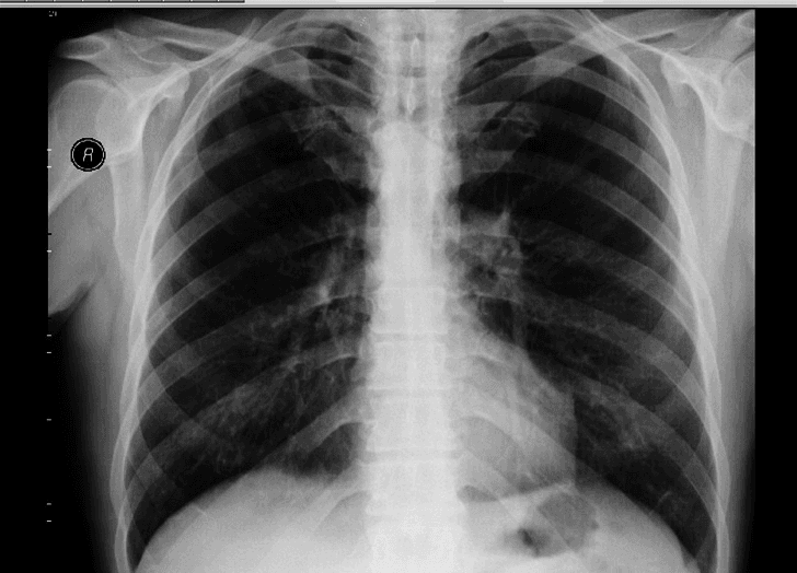 **Imaging Modality:** Posteroanterior (PA) Chest X-ray.

**Anatomical Region:** Thoracic cavity, including the lungs, rib cage, mediastinum, and diaphragm.

**Observed Pathology:** Bilateral pulmonary hyperlucency and lung overexpansion. The image demonstrates signs of chronic obstructive pulmonary disease (COPD) or emphysema. 

**Characteristic Visual Features:**
*   **Lungs:** Marked bilateral hyperlucency of the lung parenchyma with a noticeable reduction in vascular markings, particularly in the upper and mid-zones.
*   **Diaphragm:** Flattening of both diaphragmatic domes, indicating significant pulmonary hyperinflation.
*   **Rib Cage:** Increased width of the intercostal spaces and a more horizontal orientation of the ribs.
*   **Mediastinum:** The heart silhouette appears relatively narrow or "drop-shaped," a common secondary finding in hyperinflated lungs.
*   **Costophrenic Angles:** Blunting or widening due to the flattened diaphragm.

**Key Diagnostic Features:** The combination of diffuse bilateral hyperlucency, flattened diaphragmatic contours, and increased retrosternal/intercostal space is highly characteristic of diffuse obstructive lung disease. No acute focal consolidations, large pleural effusions, or pneumothoraces are visualized.