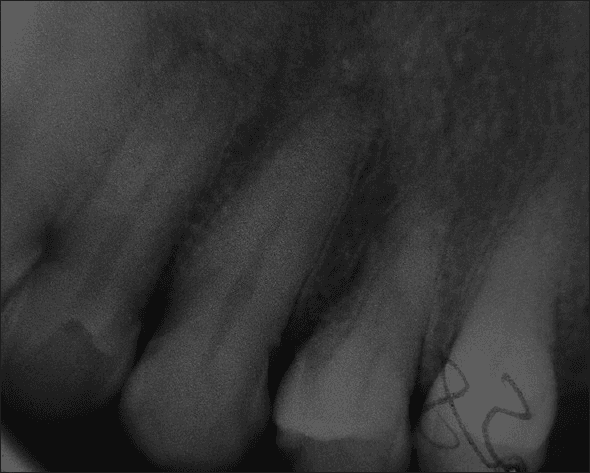 **Imaging Modality:** Intraoral periapical radiograph.

**Anatomical Region:** Maxillary anterior segment, showing multiple permanent incisors and associated alveolar bone.

**Observed Pathology/Diagnostic Features:** 
The radiograph demonstrates significant image degradation due to a "film fog" or "static electricity" artifact. Specifically, there is a prominent, radiopaque, tree-like or "lightning bolt" branching pattern superimposed over the crown of a lateral tooth. This is a characteristic static discharge artifact often caused by rapid removal of the film from its packet or low humidity environments during processing.

**Additional Radiographic Findings:**
- **Dental Anatomy:** The teeth show intact pulp chambers and root canals with no immediate evidence of periapical radiolucency.
- **Bone Quality:** The interdental alveolar bone displays a normal trabecular pattern, though visual clarity is reduced by generalized graininess and poor contrast (radiographic noise).
- **Restorations:** A radiopaque restorative material is visible on the incisal/proximal aspect of one of the central incisors.

**Key Features for Retrieval:** Dental radiography, static discharge artifact, film fog, maxillary incisors, periapical view, technical processing error.