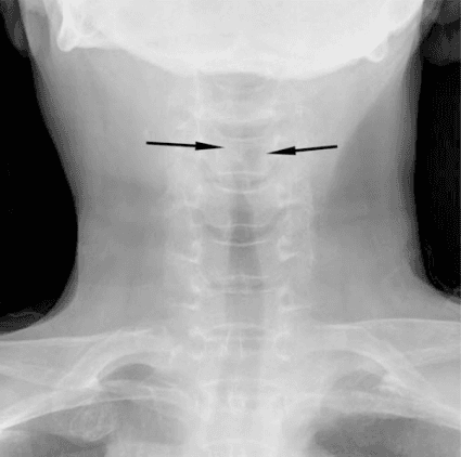 **Imaging Modality:** Anteroposterior (AP) plain film radiograph (X-ray).

**Anatomical Region:** Soft tissue of the neck and upper respiratory tract.

**Observed Pathology:** Subglottic narrowing of the airway column.

**Characteristic Visual Features:** The image demonstrates a characteristic "steeple sign" (or "pencil point sign"), characterized by symmetrical, subglottic narrowing of the tracheal air column. This narrowing is caused by inflammatory soft tissue edema in the subglottic region. The proximal tracheal lumen is significantly constricted compared to the distal segment.

**Key Diagnostic Features:** The tapering of the upper airway on an AP view is a classic radiologic hallmark of Croup (laryngotracheobronchitis). This feature helps differentiate the condition from epiglottitis, which typically presents with a "thumbprint sign" on a lateral neck radiograph.

**Clinical Context:** The findings are highly suggestive of acute inflammatory airway obstruction in the subglottic space, typically seen in pediatric populations presenting with respiratory distress or stridor.
