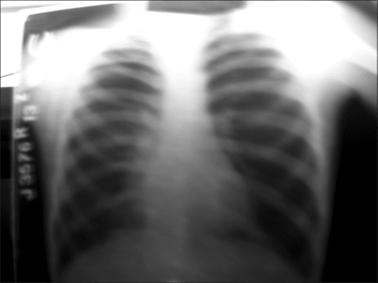 **Imaging Modality:** Posterior-Anterior (PA) Chest X-ray.

**Anatomical Region:** Thoracic cavity, including the lungs, mediastinum, and diaphragm.

**Observed Pathology:** Signs consistent with pulmonary emphysema and chronic obstructive pulmonary disease (COPD).

**Characteristic Visual Features:**
- **Hyperinflation:** Bilateral lung fields demonstrate increased radiolucency (hyperlucency) and increased lung volume.
- **Diaphragmatic Changes:** Notable flattening of the hemidiaphragms, indicating significant air trapping.
- **Rib Configuration:** Increased intercostal spacing and more horizontal orientation of the ribs.
- **Mediastinal Appearance:** The heart appears relatively narrow or "tubular" (vertical heart) due to the downward pressure from hyperinflated lungs.
- **Vascularity:** Attenuation or pruning of peripheral pulmonary vascular markings, particularly in the upper zones.

**Key Diagnostic Features:** The combination of a flattened diaphragm, increased retrosternal space (implied by hyperlucency), and hyperinflated lung parenchyma are hallmark radiographic indicators of emphysematous changes.

**Technical Note:** The image shows significant motion blur and overexposure in the superior regions, which may limit the evaluation of apical lung parenchyma.