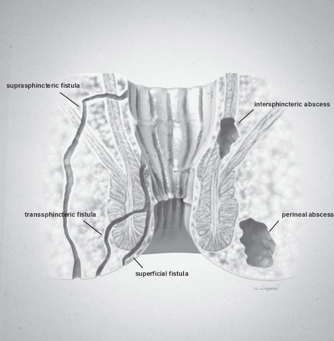 **Imaging Modality:** Medical illustration/Anatomical diagram.

**Anatomical Region:** Coronal cross-section of the anorectal region, including the anal canal, rectum, internal and external anal sphincters, and surrounding perianal soft tissues.

**Observed Pathology:** The illustration classifies various types of anorectal fistulas and abscesses based on their anatomical trajectory and location.

**Characteristic Visual Features:**
*   **Fistula Tracts:** Three distinct epithelial-lined tracks are labeled. A **superficial fistula** is shown confined to the perianal skin and distal anal canal. A **transsphincteric fistula** is depicted crossing both the internal and external sphincter muscles into the ischioanal fossa. A **suprasphincteric fistula** is illustrated looping above the puborectalis muscle before descending to the skin surface.
*   **Abscess Formations:** Two localized collections of fluid/pus are identified. An **intersphincteric abscess** is positioned within the space between the internal and external sphincter muscles. A **perineal (perianal) abscess** is shown as a larger pocket located in the subcutaneous tissue adjacent to the anal verge.

**Key Diagnostic Features:** The diagram emphasizes the relationship between inflammatory tracts and the sphincter complex, following the Parks classification system for fistula-in-ano. Suitable for clinical education on perianal sepsis and surgical planning.