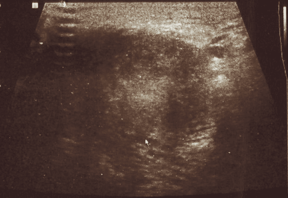 **Modality:** Ultrasonography (Grayscale)
**Anatomical Region:** Vulva / Perineal soft tissue

**Description:**
The image displays a grayscale ultrasound of the vulvar region. Centered within the field of view is a well-circumscribed, predominantly hypoechoic mass measuring approximately 2.9 × 2.5 × 2.1 cm. The internal echo texture of the lesion is heterogeneous, containing subtle internal echoes and areas of low-level echogenicity. 

**Characteristic Visual Features:**
*   **Margination:** The borders of the mass appear relatively distinct from the surrounding subcutaneous tissue.
*   **Echogenicity:** The lesion is hypoechoic compared to the adjacent fibroadipose tissue.
*   **Acoustic Features:** There is evidence of posterior acoustic enhancement, suggesting a fluid-filled or highly cellular cystic nature, often associated with lesions such as a Bartholin’s gland cyst or abscess.
*   **Artifacts:** Significant posterior acoustic shadowing is absent; however, lateral edge shadowing is visible at the margins of the mass.

**Clinical Significance:**
Findings are consistent with a localized vulvar mass or cyst. The appearance requires differentiation between inflammatory processes (e.g., abscess), benign cystic lesions (e.g., Bartholin's cyst), or solid soft tissue neoplasms.