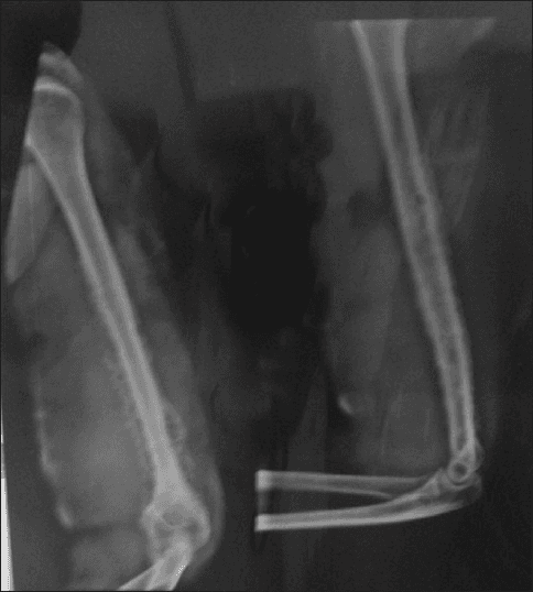**Imaging Modality:** Plain projectional radiography (X-ray)

**Anatomical Region:** Right humerus, including the shoulder and elbow joints.

**Observed Pathology:** Chronic osteomyelitis of the humeral shaft.

**Characteristic Visual Features:**
The image demonstrates significant cortical thickening and medullary canal narrowing throughout the diaphysis of the humerus. There is evidence of exuberant periosteal reaction resulting in an irregular, thickened involucrum surrounding the bone. Intracortical lucencies are visible, suggesting the presence of cloacae or areas of active infection. Dense, sclerotic segments within the marrow space are consistent with sequestrum formation (necrotic bone fragments). The overall bone morphology appears distorted and enlarged with a "bone-within-bone" appearance in certain segments.

**Key Diagnostic Features:**
- **Involucrum:** Thick layer of new bone growth around the infected site.
- **Sequestrum:** Focal areas of increased radiodensity representing devitalized bone.
- **Cloaca:** Focal cortical defects/lucencies for pus drainage.
- **Sclerosis:** Generalized increase in bone density associated with chronic inflammatory response.

**Clinical Context:** These radiologic findings are pathognomonic for long-standing, chronic pyogenic osteomyelitis.