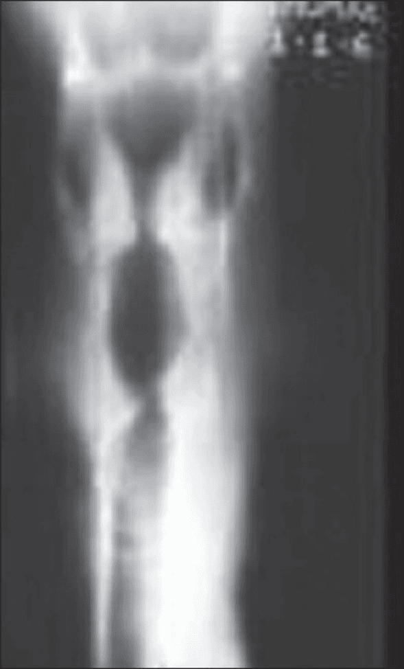 **Imaging Modality:** Plain radiograph (X-ray)

**Anatomical Region:** Neck and upper airway (Anteroposterior view)

**Observed Pathology:** The image demonstrates a characteristic narrowing of the subglottic airway, appearing as a tapered, inverted "V" or "church steeple" shape.

**Characteristic Visual Features:**
*   **Steeple Sign:** Symmetric subglottic narrowing due to inflammatory edema in the subglottic region.
*   **Airway Patency:** Contrast between the radiolucent (dark) air-filled column and the surrounding radiopaque (light) soft tissue highlights the funnel-shaped tapering.
*   **Landmarks:** The narrowing begins below the level of the vocal cords and extends into the upper trachea.

**Relevant Clinical Context:** This radiologic finding is classically associated with Croup (laryngotracheobronchitis), a common cause of upper airway obstruction in pediatric patients.

**Key Diagnostic Features:** The symmetric, progressive tapering of the subglottic air column (Steeple Sign) distinguishes this condition from epiglottitis, which typically shows a "thumb sign" on lateral neck radiographs rather than subglottic narrowing on the anteroposterior view.