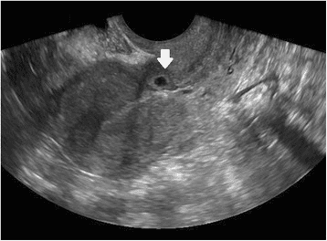 **Imaging Modality:** Transvaginal Ultrasound (TVUS), B-mode.

**Anatomical Region:** Sagittal view of the uterus, specifically the lower uterine segment and the anterior uterine wall at the level of the isthmus.

**Observed Pathology:** Cesarean scar ectopic pregnancy (CSEP).

**Characteristic Visual Features:**
*   **Gestational Sac (GS):** An anechoic, rounded structure (indicated by a white arrow) is visible embedded within the anterior myometrium of the lower uterine segment.
*   **Localization:** The sac is positioned at the site of a previous cesarean section scar, anterior to the cervical-isthmic junction. 
*   **Uterine Cavity:** The endometrial canal and the superior uterine cavity are empty, showing no evidence of intra-cavitary pregnancy.
*   **Myometrial Thinning:** There is a visible reduction in the thickness of the myometrium between the gestational sac and the bladder interface (serosa).

**Diagnostic Differentiating Features:** The primary diagnostic cue is the "empty uterus sign" combined with the low implantation of the gestational sac within the anterior wall defect, distinctly separate from the endometrial canal. This distinguishes the finding from a cervical ectopic pregnancy or a low intrauterine pregnancy.