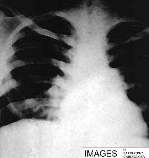 **Imaging Modality:** Frontal Chest X-ray (CXR).

**Anatomical Region:** Thoracic cavity, focusing on the cardiomediastinal silhouette and pulmonary vasculature.

**Observed Pathology:** Findings are consistent with cor pulmonale secondary to severe pulmonary hypertension. 

**Characteristic Visual Features:**
*   **Cardiac Morphology:** Pronounced cardiomegaly with a "boot-shaped" appearance, characterized by an upturned apex and a prominent right heart border, indicating right ventricular and right atrial hypertrophy.
*   **Vascular Markings:** Significant prominence and dilation of the central pulmonary arteries (hilar engorgement). There is a marked discrepancy between the enlarged central vessels and the "pruning" or attenuation of peripheral pulmonary vascular markings.
*   **Mediastinum:** Expansion of the transverse cardiac diameter and a bulging pulmonary trunk segment along the left heart border.
*   **Lung Fields:** Increased lucency in the peripheral lung zones due to decreased perfusion (oligemia).

**Diagnostic Cues:** The combination of central pulmonary artery dilation and right-sided heart enlargement without signs of left-sided failure (e.g., absence of Kerley B lines or pleural effusions) is highly suggestive of pulmonary arterial hypertension leading to chronic cor pulmonale.