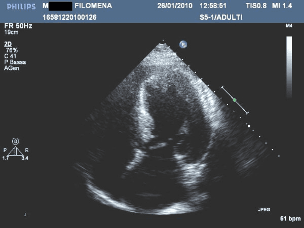**Imaging Modality:** 2D Transthoracic Echocardiogram (TTE).

**Anatomical View:** Apical four-chamber view.

**Observed Pathology:** End-stage hypertrophic cardiomyopathy (HCM) characterized by significant, diffuse left ventricular (LV) hypertrophy. Unlike the typical progression to a "burnt-out" phase involving wall thinning and cavity dilation, this image demonstrates persistent, marked concentric wall thickening of the interventricular septum and lateral wall.

**Visual Features:**
- **Ventricular Morphology:** Prominent myocardial thickening with a non-dilated left ventricular cavity.
- **Myocardial Texture:** Increased echogenicity of the myocardium, suggesting possible replacement fibrosis.
- **Cardiac Function:** Impaired systolic function is evidenced by reduced end-systolic inward movement and wall thickening (reported LVEF 40%).
- **Landmarks:** Visible left atrium, right atrium, and right ventricle appearing proportionately smaller than the hypertrophied left ventricle.

**Diagnostic Significance:** This image represents the hypokinetic-restrictive stage of HCM. The key differentiating feature is the presence of moderate systolic dysfunction (EF <50%) without the ventricular wall thinning usually associated with dilated cardiomyopathy or late-stage remodeling, signifying advanced disease progression.