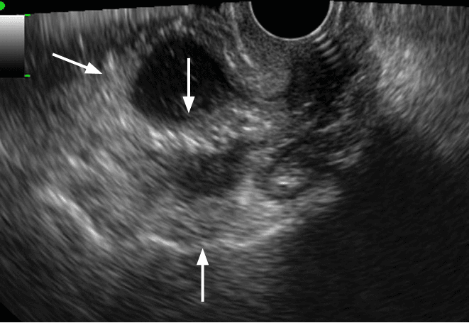 **Imaging Modality:** Transvaginal Ultrasound (TVUS)

**Anatomical Region:** Pelvis (Adnexa)

**Observed Pathology:** Tubo-ovarian abscess (TOA)

**Characteristic Visual Features:**
The image displays a complex, multilocular cystic adnexal mass. Key sonographic features include:
*   **Wall Morphology:** Distinct, regular thickening of the outer capsule and internal septations (indicated by arrows).
*   **Internal Content:** The cystic spaces contain low-level internal echogenic debris/fluid, consistent with purulent material or complex fluid.
*   **Architecture:** The mass lacks solid papillary projections but exhibits a "cogwheel" or "beaded" appearance characteristic of inflammatory adnexal processes involving the fallopian tube and ovary.

**Diagnostic Differentiating Features:**
The presence of thick, regular walls and septa combined with internal echogenicity helps differentiate this inflammatory complex from simple ovarian cysts or hydrosalpinx. The lack of irregular solid components or high-vascularity nodules (not visible here) helps distinguish it from malignant epithelial ovarian tumors. This presentation is highly suggestive of Pelvic Inflammatory Disease (PID) progressing to a tubo-ovarian abscess.