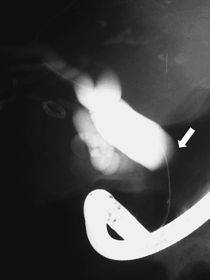 **Imaging Modality:** Endoscopic Retrograde Cholangiopancreatography (ERCP), fluoroscopic view.

**Anatomical Region:** Hepatobiliary system, specifically the extrahepatic and intrahepatic bile ducts.

**Observed Pathology:** The cholangiogram reveals significant obstructive jaundice morphology. There is marked dilatation of the intrahepatic bile ducts and the proximal extrahepatic biliary tree. A high-grade biliary stricture is evidenced by the abrupt, blunt termination of the mid-portion of the common bile duct (marked by a white arrow), suggesting an extrinsic or intrinsic malignant compression consistent with neoplastic disease (e.g., cholangiocarcinoma or pancreatic head mass).

**Characteristic Visual Features:** 
- **Biliary Tree:** Opacification shows dilated proximal ducts contrasting with a complete lack of distal flow.
- **Stricture:** Sudden "cutoff" sign or abrupt termination of the contrast column.
- **Instrumentation:** An endoscope is visible in the inferior portion of the frame, with a guidewire traversing the biliary system in preparation for stent placement.

**Key Diagnostic Features:** The morphology of the abrupt termination and proximal ductal expansion are hallmark radiologic indicators of high-grade mechanical biliary obstruction requiring therapeutic intervention.