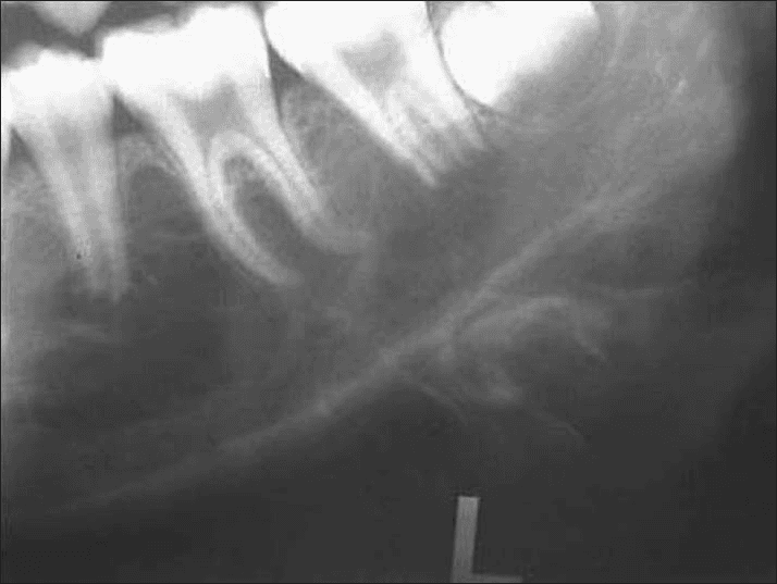 **Imaging Modality:** Intraoral periapical radiograph.

**Anatomical Region:** Posterior region of the mandible, including molars and the inferior mandibular border.

**Observed Pathology:** Large, ill-defined radiolucent lesion involving the body of the mandible with aggressive periosteal reaction. 

**Characteristic Visual Features:**
*   **Periosteal Reaction:** Prominent "sunray" or "sunburst" appearance characterized by divergent, thin radiopaque spicules of bone extending perpendicular to the cortical surface.
*   **Bone Destruction:** Irregular destruction of the medullary bone and thinning/perforation of the inferior cortical plate.
*   **Dental Involvement:** Displacement of the permanent molars and loss of the lamina dura surrounding the roots of the involved teeth.
*   **Soft Tissue Extension:** The radiating bony spicules extend into the adjacent soft tissue space.

**Diagnostic Differentiating Features:** The aggressive "sunburst" periosteal pattern is a classic radiologic hallmark of osteosarcoma of the jaw, distinguishing it from benign reactive processes or chronic osteomyelitis. The combination of osteolysis and osteogenesis suggests a high-grade malignant bone tumor.