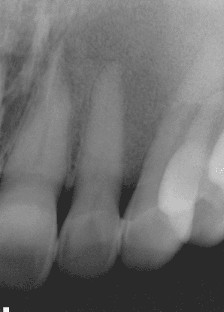 **Imaging Modality:** Intraoral periapical radiograph.

**Anatomical Region:** Anterior maxillary dentition and associated alveolar bone.

**Observed Pathology:** A radiopaque osseous lesion exhibiting a characteristic "ground-glass" or "orange peel" appearance. The lesion shows an ill-defined, blending anterior border that merges imperceptibly with the surrounding normal bone.

**Characteristic Visual Features:**
*   **Trabecular Alteration:** Normal trabecular patterns are replaced by a dense network of shorter, irregularly shaped, and more numerous trabeculae, resulting in increased radiopacity.
*   **Periodontal Changes:** There is a generalized loss of the lamina dura surrounding the roots of the involved teeth.
*   **Expansion:** The image suggests a subtle expansion of the alveolar bone, though the cortical outlines remain largely intact.

**Key Diagnostic Features:** The combination of a diffuse, poorly demarcated border, ground-glass internal radiopacity, and loss of lamina dura is highly suggestive of fibro-osseous dysplasia, such as fibrous dysplasia. The absence of a discrete radiolucent rim distinguishes this from typical odontogenic tumors.