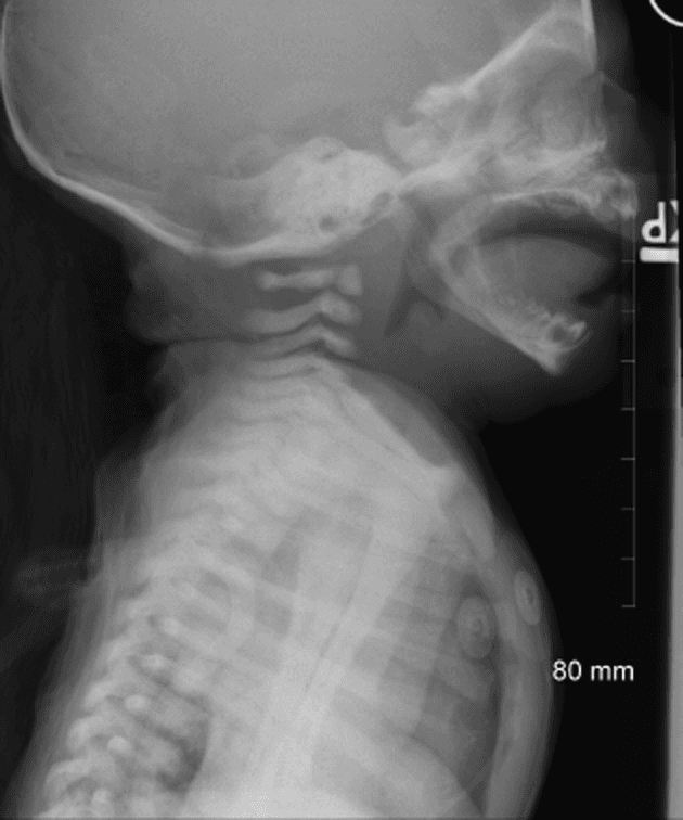 **Imaging Modality:** Lateral soft tissue X-ray of the neck and upper thorax.

**Anatomical Region:** Pediatric cervical airway and upper respiratory tract.

**Observed Pathology:** Findings are highly indicative of acute epiglottitis (supraglottitis).

**Characteristic Visual Features:**
*   **"Thumb Sign":** Significant enlargement and rounding of the epiglottis, resulting in a thick, bulbous appearance resembling a thumb.
*   **Aryepiglottic Folds:** Notable thickening and convex bowing of the aryepiglottic folds.
*   **Arytenoid Enlargement:** Prominent swelling of the arytenoid soft tissues.
*   **Hypopharyngeal Distension:** Compensatory dilatation of the hypopharynx proximal to the site of supraglottic narrowing.
*   **Airway Caliber:** Reduction in the patency of the laryngeal inlet due to massive soft tissue edema.

**Key Diagnostic Features:** The combination of the "thumb sign" and thickened aryepiglottic folds on a lateral view are pathognomonic for epiglottitis, distinguishing it from the "steeple sign" associated with subglottic narrowing in laryngotracheobronchitis (croup). Electrodes are visible on the chest wall, indicating clinical monitoring.
