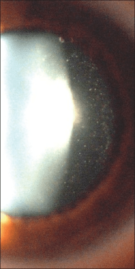 **Imaging Modality:** Slit-lamp biomicroscopy photograph of the anterior segment.

**Anatomical Region:** Crystalline lens and anterior vitreous chamber.

**Observed Pathology:** The image demonstrates a localized, dense, white crystalline opacity situated at the posterior pole of the lens, characteristic of a posterior polar cataract. Extending posterior to the lens capsule into the anterior vitreous is a diffuse distribution of fine, refractile, punctate opacities.

**Characteristic Visual Features:** 
- **Posterior Lens Opacity:** A well-defined, bright white plaque at the posterior lens cortex/capsule interface.
- **Vitreous Infiltration:** Numerous small, hyper-reflective, crystalline-like seeds or infiltrates are visible within the retro-lental space, indicating a potential compromise of the posterior capsule or an associated inflammatory/degenerative vitreous process.
- **Lighting:** Slit-beam illumination highlights the depth and axial location of the lens opacity and the suspended nature of the vitreous particles.

**Key Diagnostic Features:** The combination of a stationary posterior polar lens opacity and mobile-appearing infiltrates in the vitreous space is a critical finding for surgical planning, often indicating a pre-existing posterior capsular defect or posterior segment involvement.