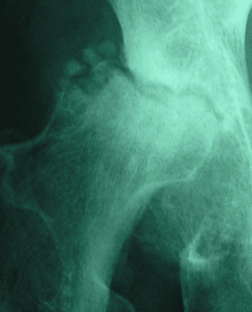 **Modality:** Plain radiography (X-ray) of the hip.

**Anatomical Region:** Proximal femur and acetabulum.

**Observed Pathology:** Advanced stage of Legg-Calvé-Perthes disease or severe avascular necrosis (AVN) of the femoral head.

**Visual Features:** 
*   **Morphology:** Significant collapse and severe flattening of the femoral head epiphysis, resulting in a characteristic "hatchet-like" deformity. 
*   **Articular Surface:** There is a pronounced eccentric depression of the lateral articular surface. 
*   **Alignment:** Evidence of superolateral subluxation of the femoral head relative to the acetabulum.
*   **Bone Density:** Marked sclerosis within the femoral head, interspersed with subchondral lucencies and defects, indicating ongoing bone remodeling and necrosis.
*   **Joint Space:** Notable joint space narrowing and incongruity between the femoral head and the acetabular roof.

**Diagnostic Features:** The combination of severe epiphyseal flattening, subchondral collapse, and lateral subluxation are hallmark signs of end-stage ischemic necrosis and joint secondary degeneration. This appearance is crucial for classifying disease severity using the Waldenström or Herring systems.