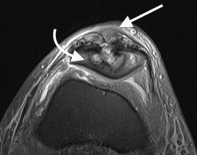 **Imaging Modality:** Magnetic Resonance Imaging (MRI), axial Proton Density-weighted (PD) with fat suppression.

**Anatomical Region:** Anterior compartment of the knee at the level of the patellofemoral joint.

**Observed Pathology:** Chronic tendinopathy and secondary osseous changes. The distal quadriceps tendon exhibits significant pathological thickening with a heterogeneous, nodular internal signal. Adjacent to the tendon insertion, there is prominent cortical irregularity and erosive change involving the anterior aspect of the patella. 

**Characteristic Visual Features:**
*   **Quadriceps Tendon:** Loss of normal thin, low-signal morphology; replaced by an expanded, intermediate-signal nodular mass (indicated by straight arrow).
*   **Patella:** Focal osseous destruction and subchondral irregularities (indicated by curved arrow) suggestive of pressure necrosis or inflammatory erosion.
*   **Joint Space:** The underlying trochlear groove and patellofemoral articulation are visible, with mild reactive fluid signal in the peritendinous tissues.

**Diagnostic Significance:** These findings are characteristic of severe, chronic quadriceps tendinosis or intratendinous tophaceous deposition (e.g., gout), which can lead to secondary bone erosion. The image serves as a reference for distinguishing tendinous hypertrophy from acute traumatic rupture.